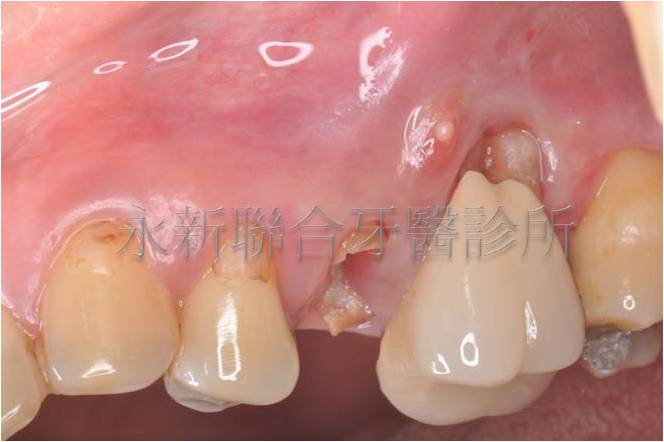 小臼齒為殘根，大臼齒是舊有牙套，有牙齦萎縮合併膿瘍