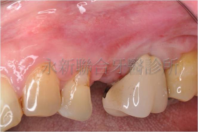 手術後牙根覆蓋術合併齒槽骨保存術頰側面，成功將萎縮的牙齦恢復舊有牙套邊