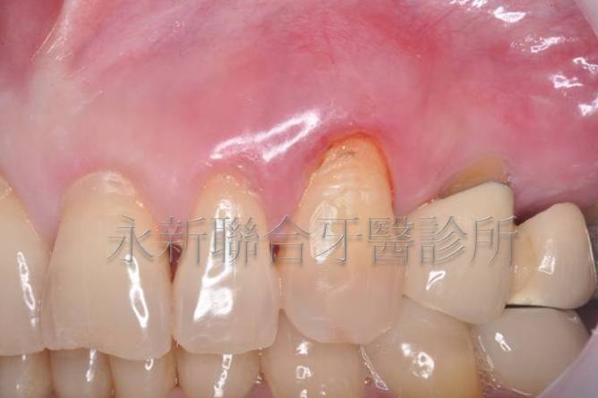 此病患有牙齦紅腫和牙結石的問題