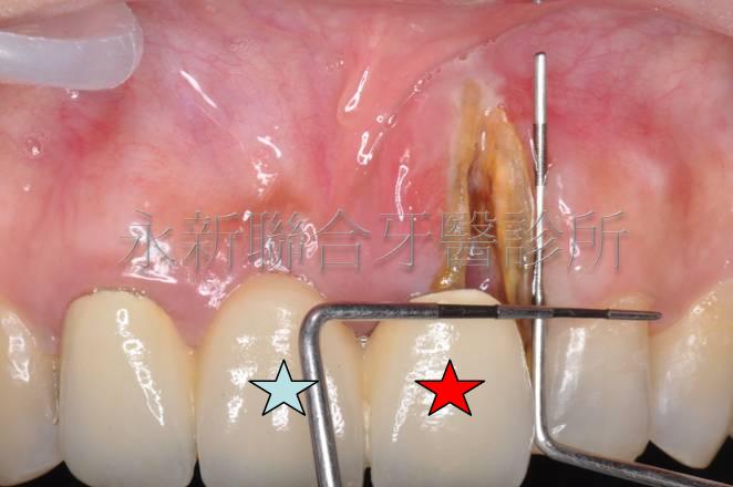牙齒裂開導致牙周破壞,使得牙齒周圍不只沒了骨頭也少了角化牙齦的保護,建議實施齒槽骨保存術(紅色星星)