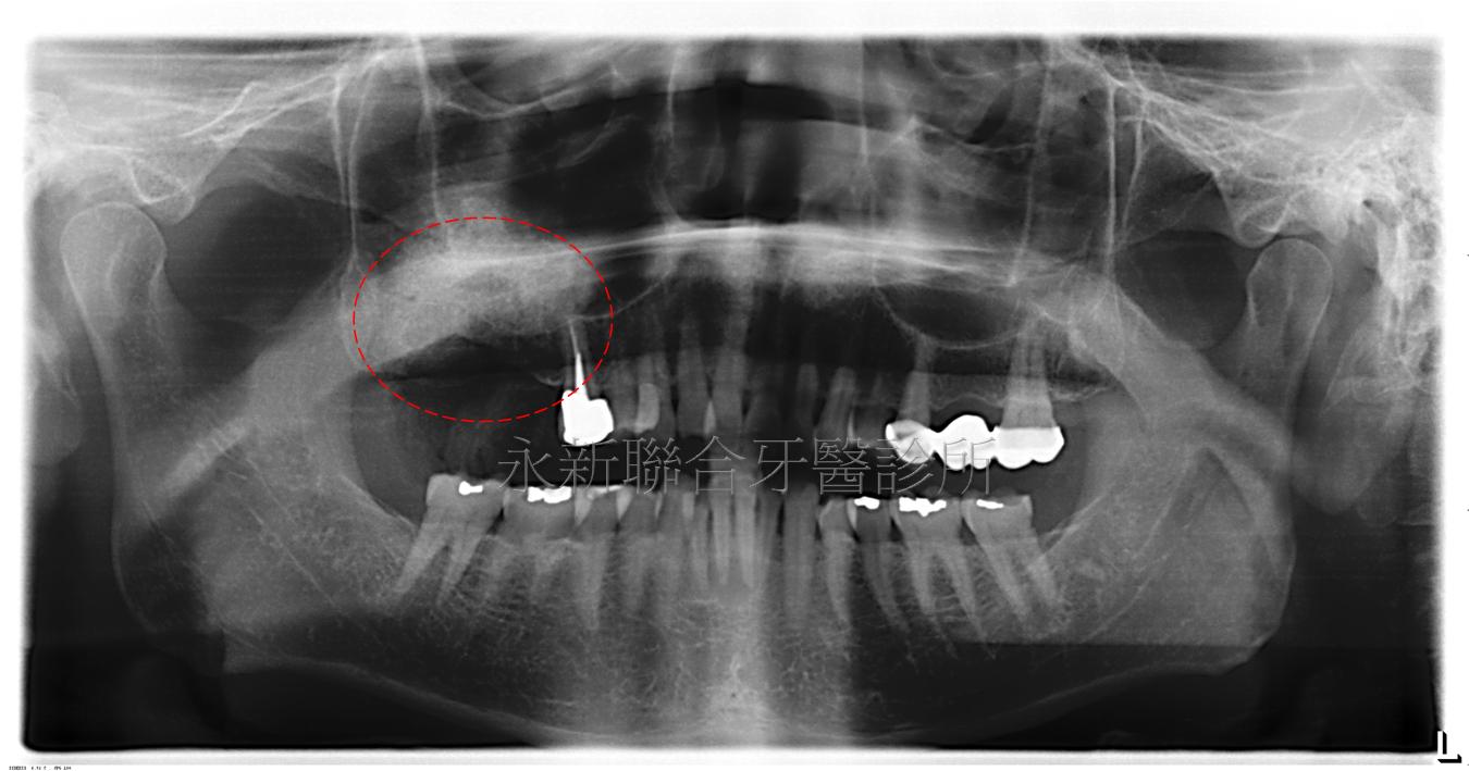 如圖紅色圈處可看出右上小臼齒牙根已經在鼻竇上，若要在右上缺牙處進行植牙則長度條件不足